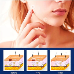 144PCS Skin Tag Remover Patches With Natural Ingredients
