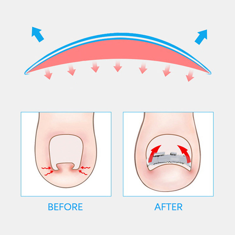 Ingrown Toenail Corrector Toe Nail Treatment Professional Foot Care Tool