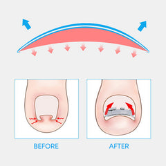 Ingrown Toenail Corrector Toe Nail Treatment Professional Foot Care Tool