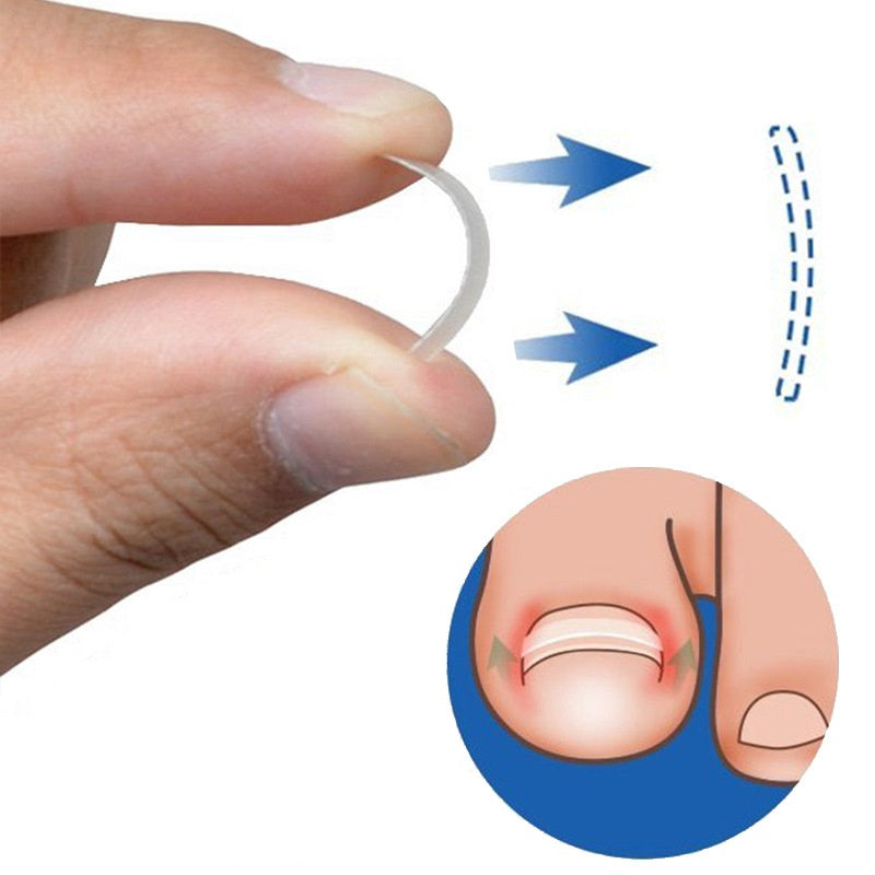 12pcs Ingrown Toe Nail Treatment Corrector Elastic Patch Sticker S