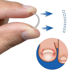 12pcs Ingrown Toe Nail Treatment Corrector Elastic Patch Sticker S