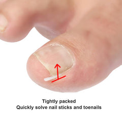 12pcs Ingrown Toe Nail Treatment Corrector Elastic Patch Sticker S