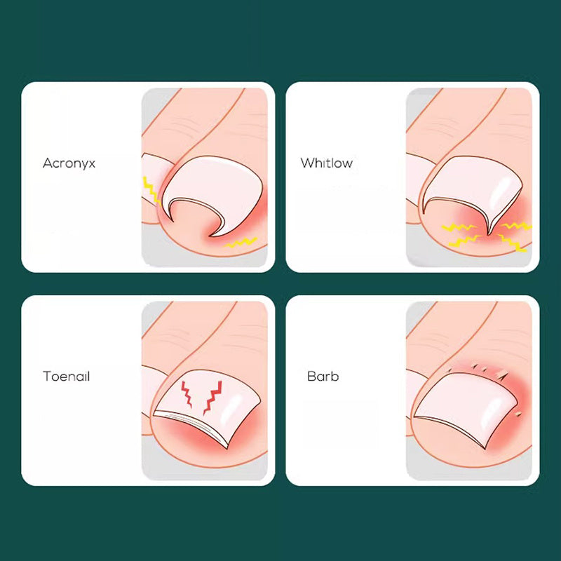 Stainless Steel Ingrown Toenail Plier for Pedicure Care