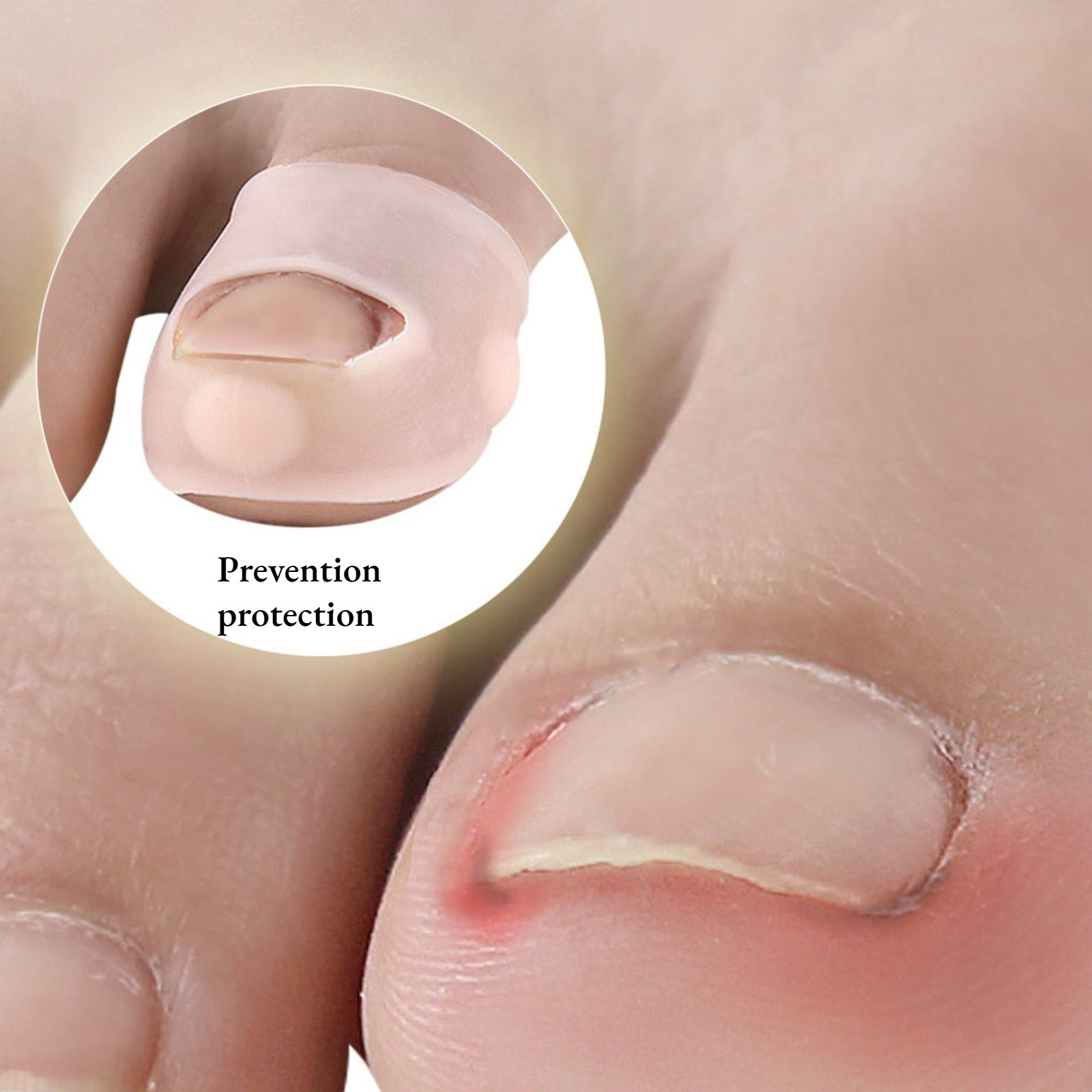 Silicone Ingrown Nail Correction Toe Device