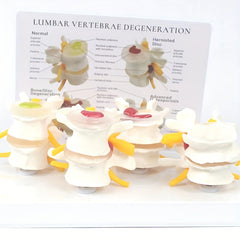 Lumbar Vertebrae Lesion Model Teaching Tool