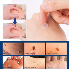 144PCS Skin Tag Remover Patches With Natural Ingredients