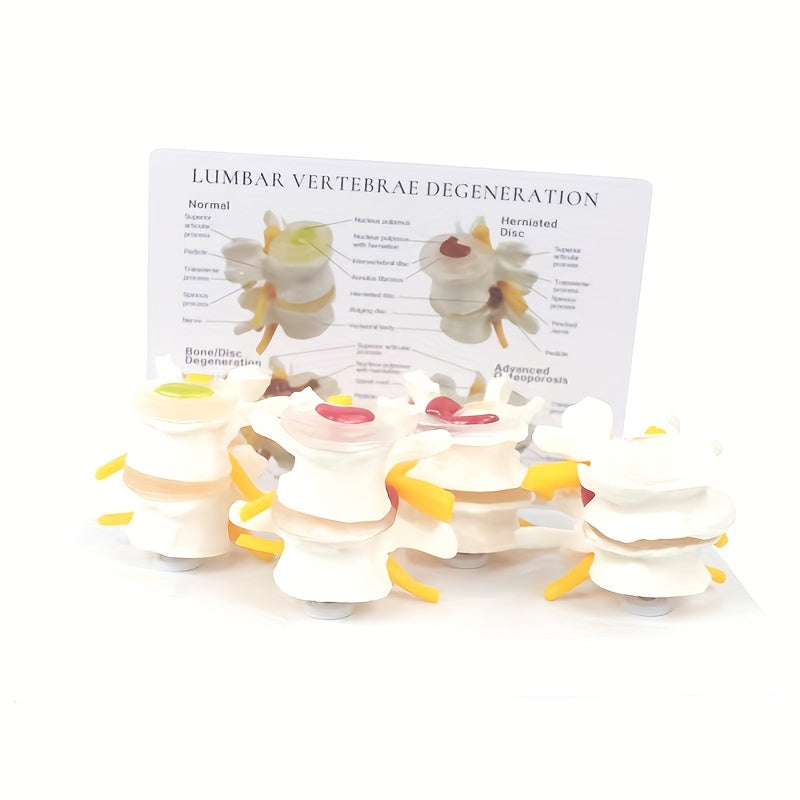 Lumbar Vertebrae Lesion Model Teaching Tool
