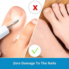 50pcs Glue Nail Correction Device Toe Nail Deformation Patch