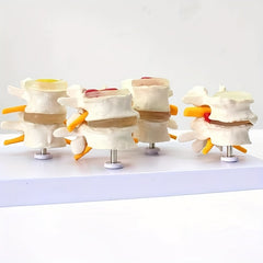 Lumbar Vertebrae Lesion Model Teaching Tool