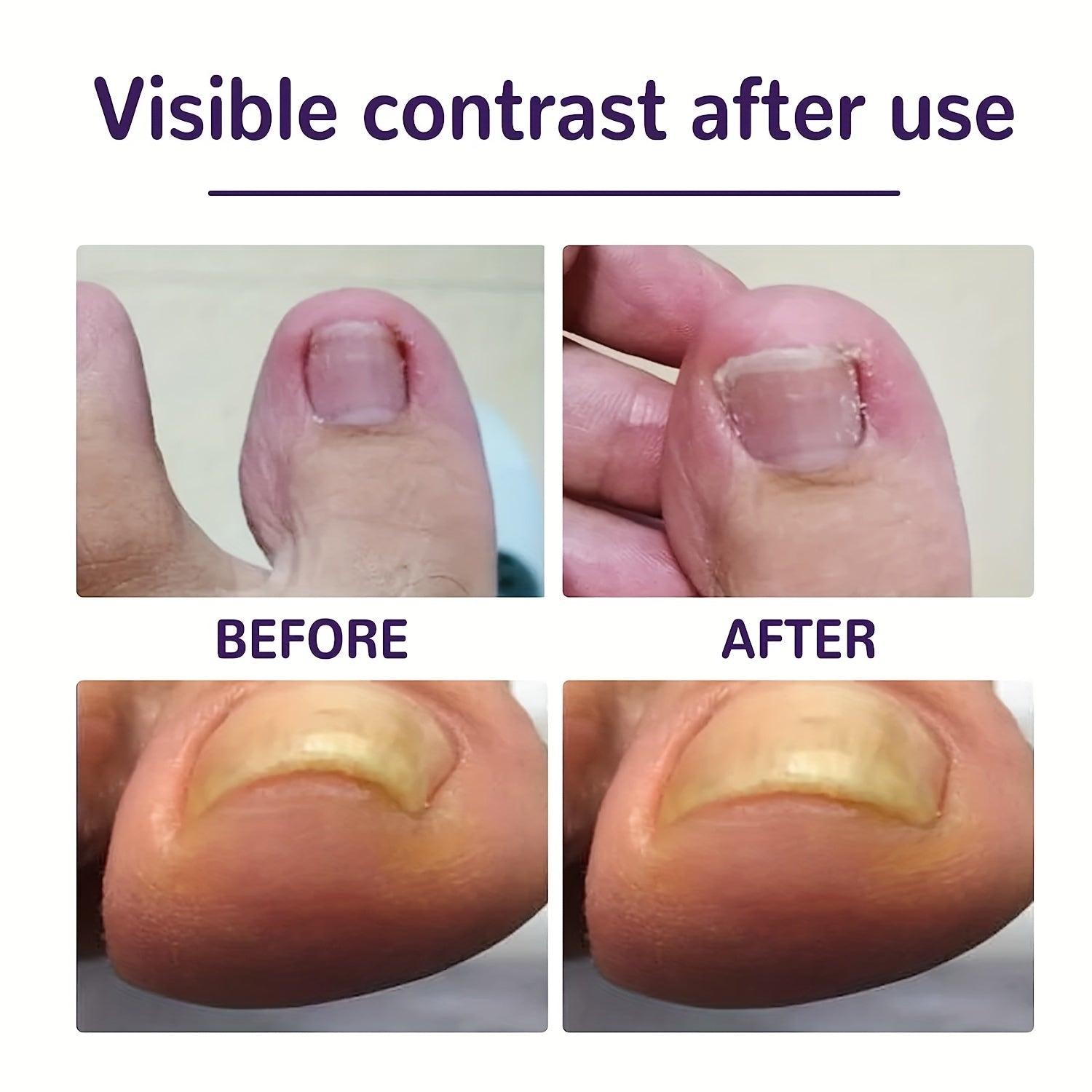 30pcs Toenail Corrector Patch Ingrown Toenail Corrector Sticker Nail Correction