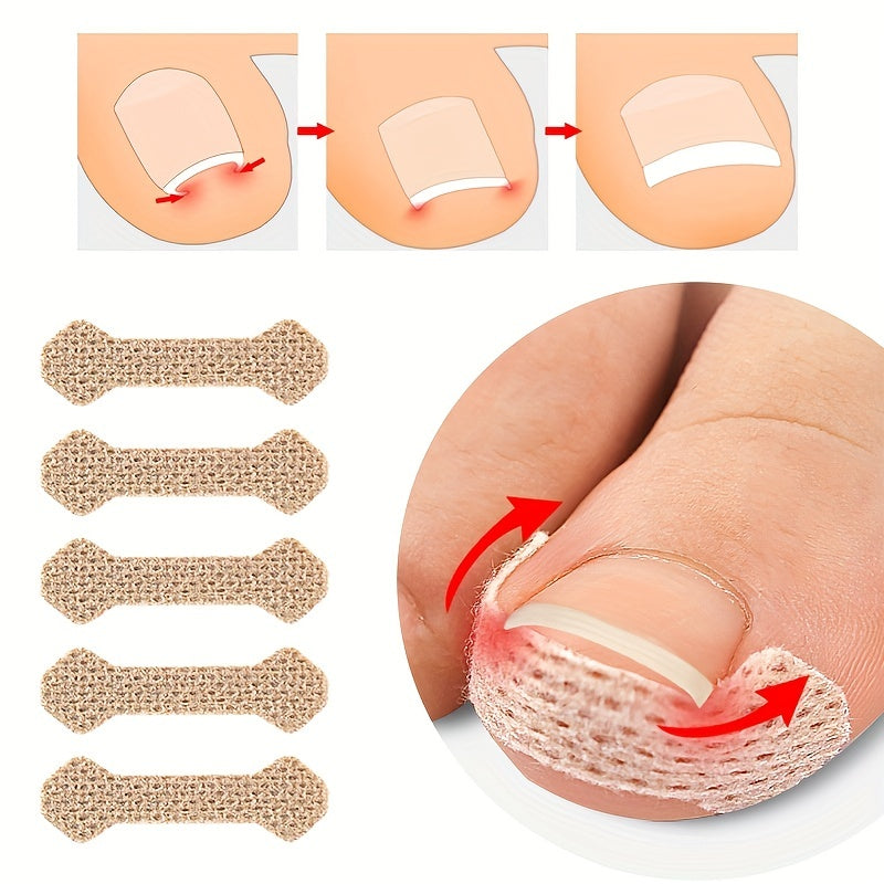 20pcs Toe Patch Set for Ingrown Toenail Relief & Nail Care Support