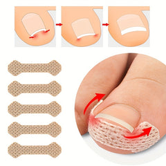 20pcs Toe Patch Set for Ingrown Toenail Relief & Nail Care Support