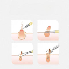 Acne Needle Blackhead Needle Set Professional Fighting Acne