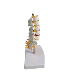 Lumbar Spine Model with Herniated Disc Sacrum & Nerves for Medical Education