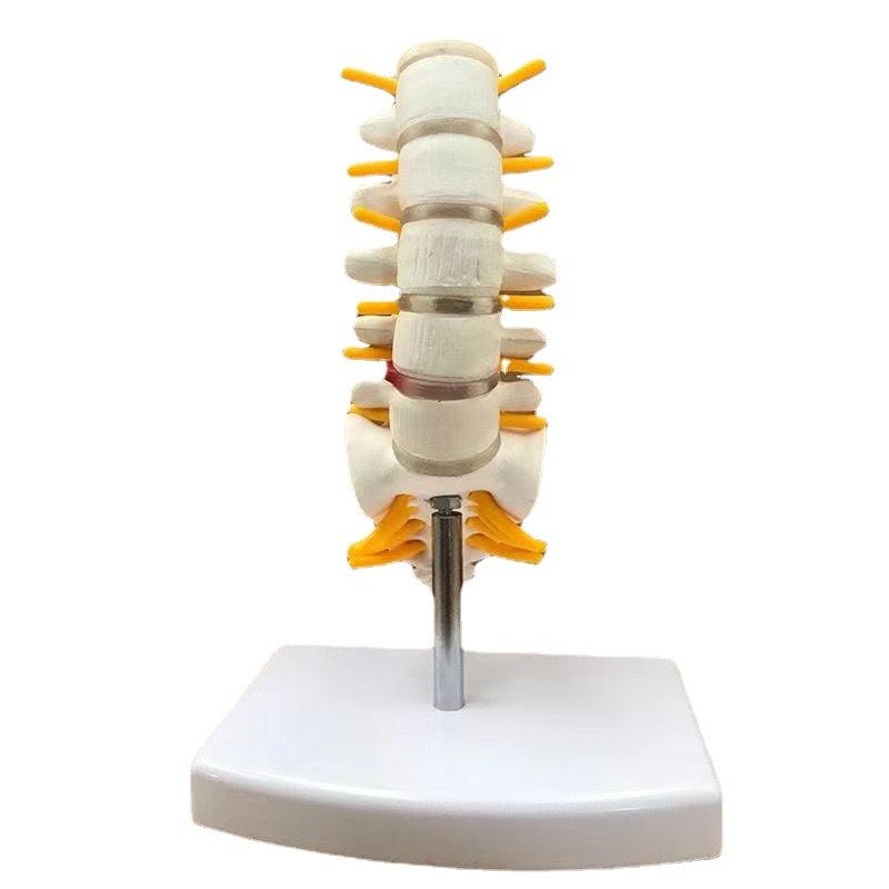Lumbar Spine Model with Herniated Disc Sacrum & Nerves for Medical Education