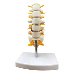 Lumbar Spine Model with Herniated Disc Sacrum & Nerves for Medical Education