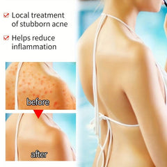 Turmeric Acne Dark Spot Removal Olive Coconut Cleanser