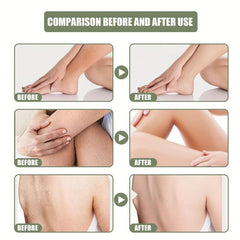 Acne Treatment Cream - Deep Cleansing & Moisturizing Exfoliator