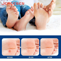 Salicylic Acid Corn Remover - Callus & Corn Removal Treatment