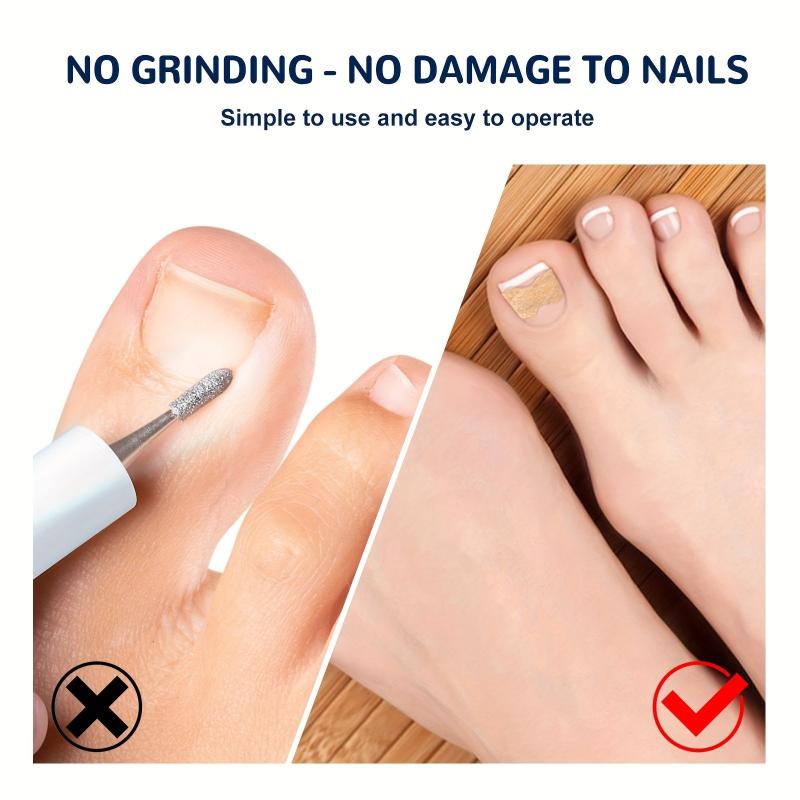 Ingrown Toenail Correction Stickers for Dark Skin Tone