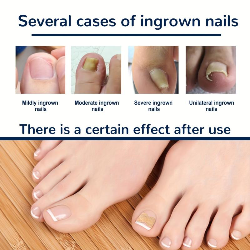 Ingrown Toenail Correction Stickers for Dark Skin Tone