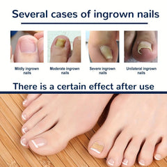 Ingrown Toenail Correction Stickers for Dark Skin Tone