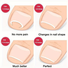 Ingrown Toenail Correction Straightening Clip Toe Nail Correction