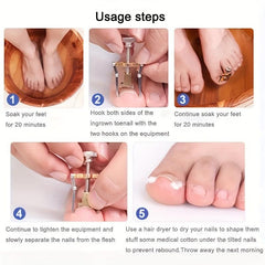 Ingrown Toenail Correction Straightening Clip Toe Nail Correction