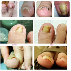Ingrown Toenail Correction Straightening Clip Toe Nail Correction