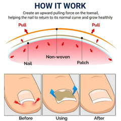 100 Pcs Ingrown Toenail Corrector Strips for Men and Women