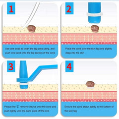 40Pcs 1.8mm Wart & Acne Removal Kit: Rubber Ring Removal & Cleansing Swabs