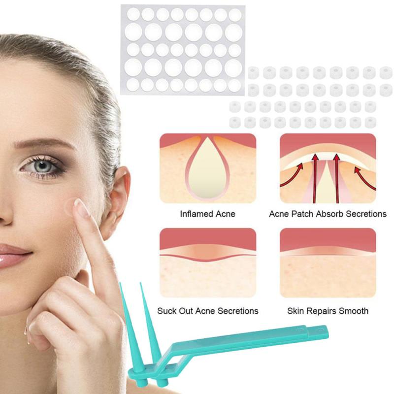 40Pcs 1.8mm Wart & Acne Removal Kit: Rubber Ring Removal & Cleansing Swabs