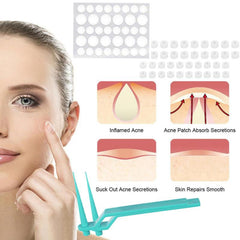 40Pcs 1.8mm Wart & Acne Removal Kit: Rubber Ring Removal & Cleansing Swabs