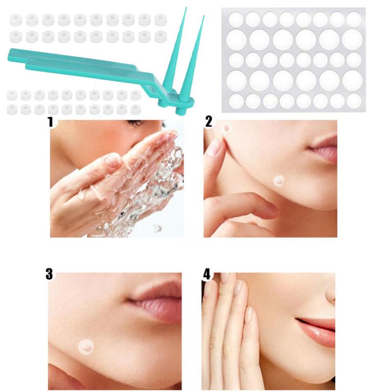 40Pcs 1.8mm Wart & Acne Removal Kit: Rubber Ring Removal & Cleansing Swabs