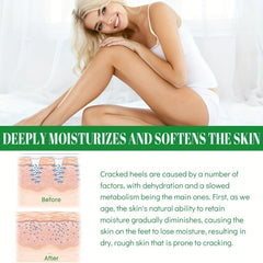 Heel Hydrating Cream for Dry Cracked Skin Callus Remover