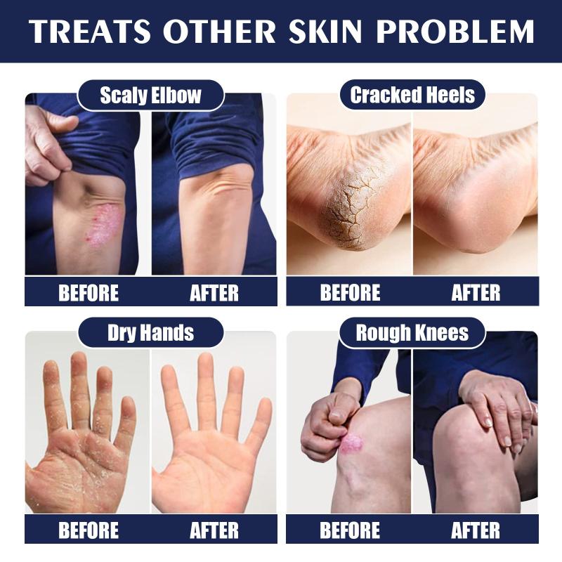 30g Hand and Foot Cream for Dry Cracked Heel Moisturizing Exfoliating Callus