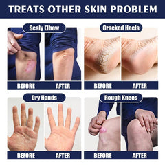 30g Hand and Foot Cream for Dry Cracked Heel Moisturizing Exfoliating Callus