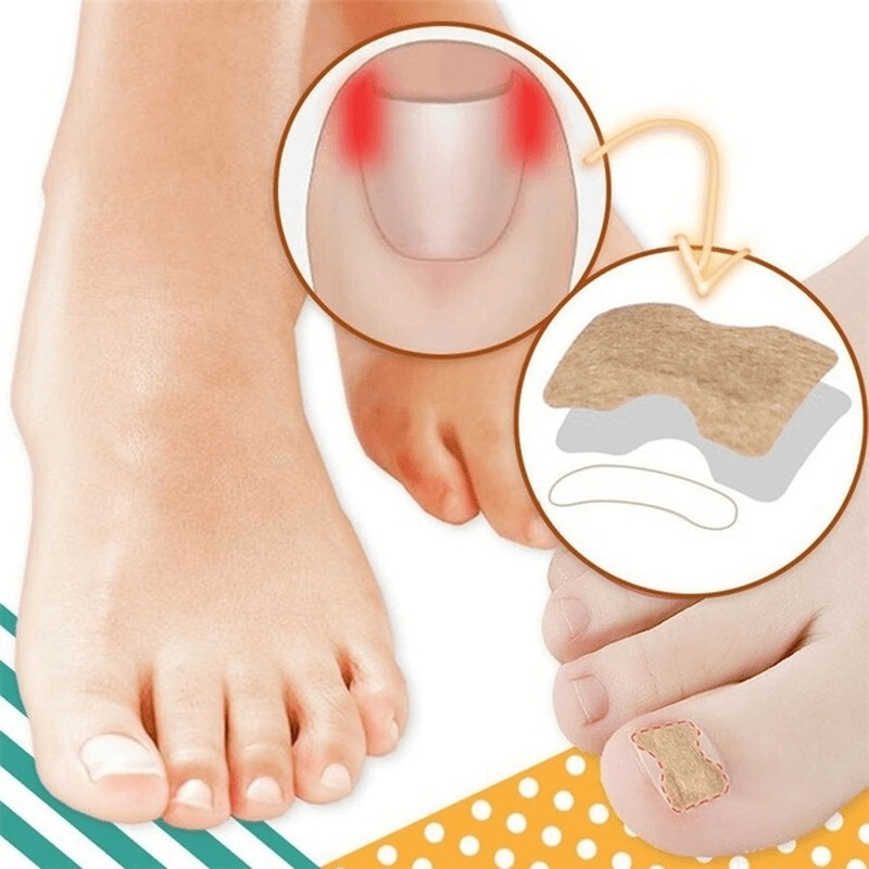 10 Pcs Ingrown Toenail Correction Sticker Glueless Corrector Strip Foot Care