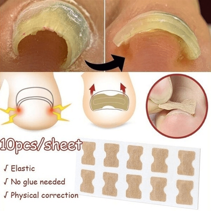 10 Pcs Ingrown Toenail Correction Sticker Glueless Corrector Strip Foot Care