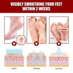 5pcs Fruit Acid Exfoliating Foot Mask - Hydrating and Moisturizing
