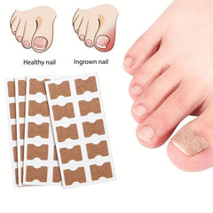 10pcs Ingrown Toenail Correction Strips Painless Pedicure Patch