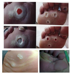 12pcs Corn Sticker Callus Foot Cushion Corn Removal Pads Toe Corn Callus Removal