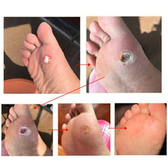 12pcs Corn Sticker Callus Foot Cushion Corn Removal Pads Toe Corn Callus Removal