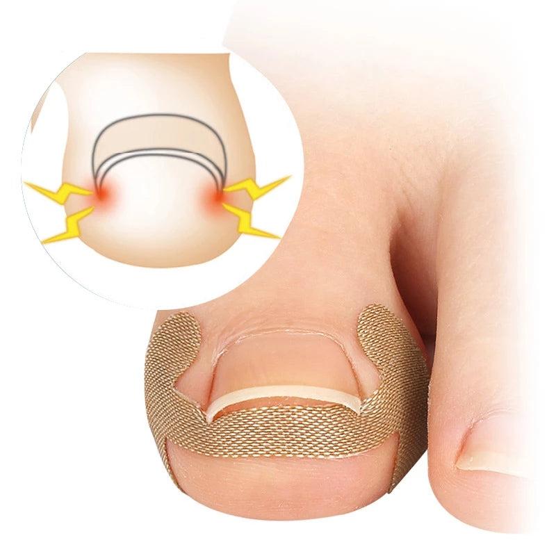 Ingrown Toenail Corrector Sticker Nail Strip Anti Roll Nail Glue Toe Inlay