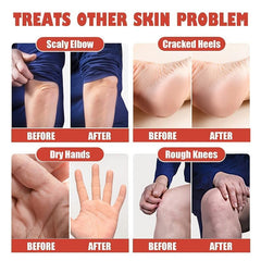 Cracked Heel Repair Cream For Dry Cracked Feet - Foot Care Dead Skin Remover