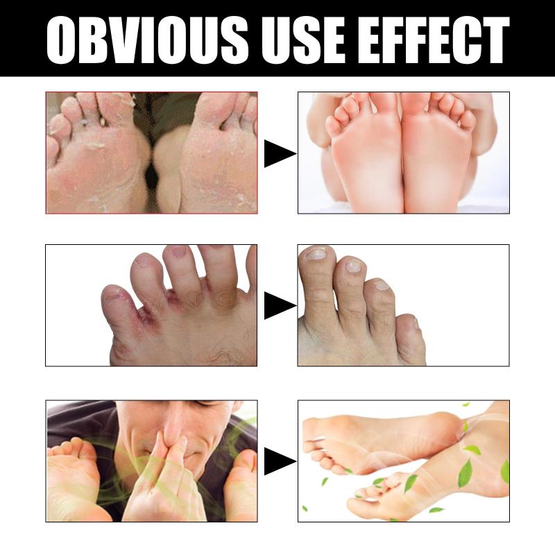 Athlete's Foot Cream For Dry Rough Cracked Skin