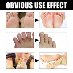 Athlete's Foot Cream For Dry Rough Cracked Skin