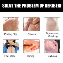 Athlete's Foot Cream For Dry Rough Cracked Skin