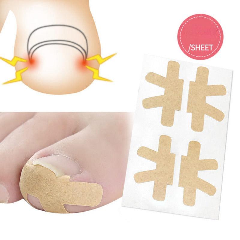Ingrown Toenail Correction: Stickers Glue Toenail Corrector Patches