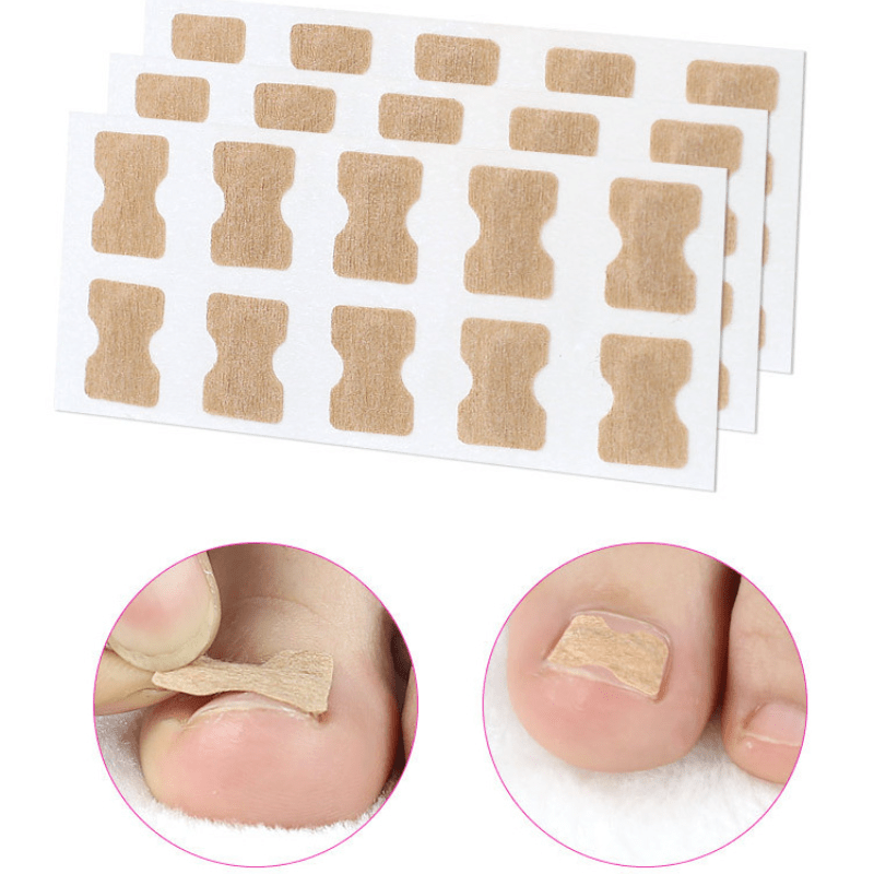 Ingrown Toenail Correction: Stickers Glue Toenail Corrector Patches